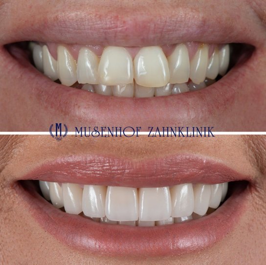 Vorher-Nachher: gelbliche Zähne mit ungleichen Kanten, darunter ein helles, gleichmäßiges Lächeln mit Veneers