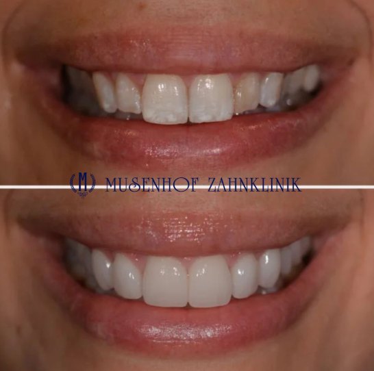 Vorher-Nachher: Zähne mit Flecken und unregelmäßiger Form, darunter einheitliche, natürlich wirkende Veneers